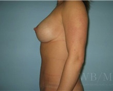 Mommy Makeover After Photo by William Bruno, MD; West Hollywood, CA - Case 51324