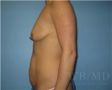 Mommy Makeover Before Photo by William Bruno, MD; West Hollywood, CA - Case 51324