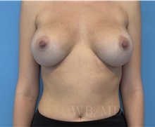 Breast Augmentation After Photo by William Bruno, MD; West Hollywood, CA - Case 51326