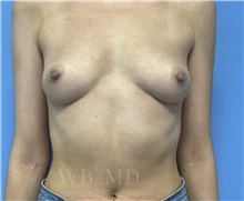 Breast Augmentation Before Photo by William Bruno, MD; West Hollywood, CA - Case 51326
