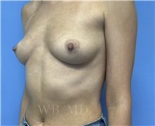 Breast Augmentation Before Photo by William Bruno, MD; West Hollywood, CA - Case 51326
