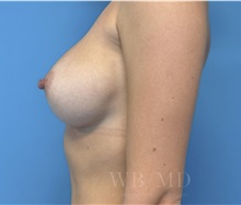 Breast Augmentation After Photo by William Bruno, MD; West Hollywood, CA - Case 51326