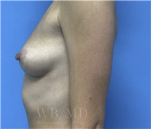 Breast Augmentation Before Photo by William Bruno, MD; West Hollywood, CA - Case 51326