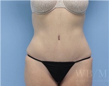 Tummy Tuck After Photo by William Bruno, MD; West Hollywood, CA - Case 51328