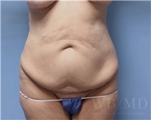 Tummy Tuck Before Photo by William Bruno, MD; West Hollywood, CA - Case 51328