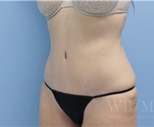 Tummy Tuck After Photo by William Bruno, MD; West Hollywood, CA - Case 51328