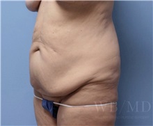 Tummy Tuck Before Photo by William Bruno, MD; West Hollywood, CA - Case 51328