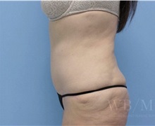 Tummy Tuck After Photo by William Bruno, MD; West Hollywood, CA - Case 51328