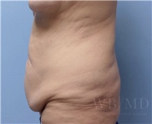 Tummy Tuck Before Photo by William Bruno, MD; West Hollywood, CA - Case 51328