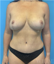 Mommy Makeover After Photo by William Bruno, MD; West Hollywood, CA - Case 51343