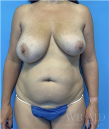 Mommy Makeover Before Photo by William Bruno, MD; West Hollywood, CA - Case 51343