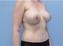 Mommy Makeover After Photo by William Bruno, MD; West Hollywood, CA - Case 51347