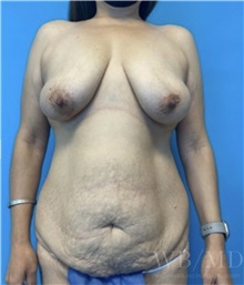 Mommy Makeover Before Photo by William Bruno, MD; West Hollywood, CA - Case 51344