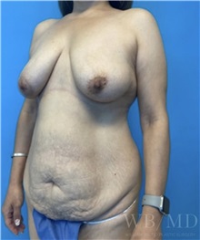 Mommy Makeover Before Photo by William Bruno, MD; West Hollywood, CA - Case 51344