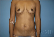 Mommy Makeover Before Photo by William Bruno, MD; West Hollywood, CA - Case 51345