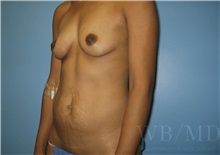 Mommy Makeover Before Photo by William Bruno, MD; West Hollywood, CA - Case 51345