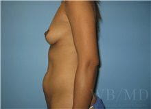 Mommy Makeover Before Photo by William Bruno, MD; West Hollywood, CA - Case 51345