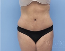 Tummy Tuck After Photo by William Bruno, MD; West Hollywood, CA - Case 51351