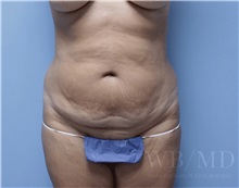 Tummy Tuck Before Photo by William Bruno, MD; West Hollywood, CA - Case 51351