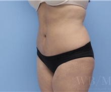 Tummy Tuck After Photo by William Bruno, MD; West Hollywood, CA - Case 51351