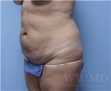 Tummy Tuck Before Photo by William Bruno, MD; West Hollywood, CA - Case 51351