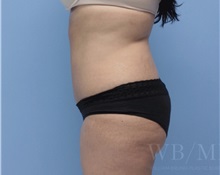 Tummy Tuck After Photo by William Bruno, MD; West Hollywood, CA - Case 51351