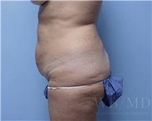 Tummy Tuck Before Photo by William Bruno, MD; West Hollywood, CA - Case 51351