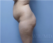 Buttock Lift with Augmentation Before Photo by William Bruno, MD; West Hollywood, CA - Case 51349