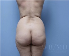 Buttock Lift with Augmentation Before Photo by William Bruno, MD; West Hollywood, CA - Case 51349