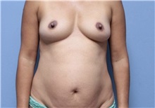Mommy Makeover Before Photo by William Bruno, MD; West Hollywood, CA - Case 51356