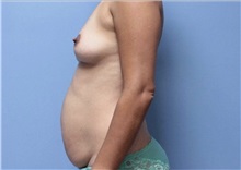 Mommy Makeover Before Photo by William Bruno, MD; West Hollywood, CA - Case 51356