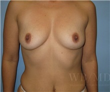 Breast Augmentation Before Photo by William Bruno, MD; West Hollywood, CA - Case 51361