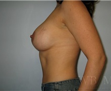 Breast Augmentation After Photo by William Bruno, MD; West Hollywood, CA - Case 51361