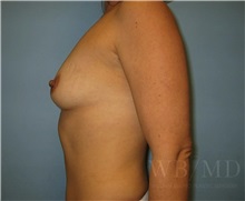 Breast Augmentation Before Photo by William Bruno, MD; West Hollywood, CA - Case 51361