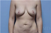 Mommy Makeover Before Photo by William Bruno, MD; West Hollywood, CA - Case 51355