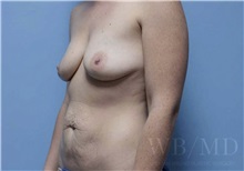 Mommy Makeover Before Photo by William Bruno, MD; West Hollywood, CA - Case 51355