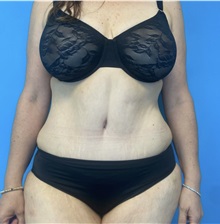 Tummy Tuck After Photo by William Bruno, MD; West Hollywood, CA - Case 51359