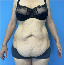 Tummy Tuck Before Photo by William Bruno, MD; West Hollywood, CA - Case 51359