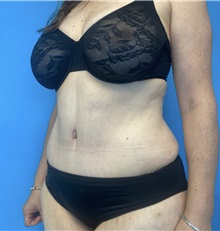 Tummy Tuck After Photo by William Bruno, MD; West Hollywood, CA - Case 51359