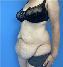 Tummy Tuck Before Photo by William Bruno, MD; West Hollywood, CA - Case 51359