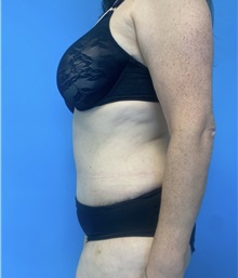 Tummy Tuck After Photo by William Bruno, MD; West Hollywood, CA - Case 51359