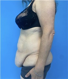 Tummy Tuck Before Photo by William Bruno, MD; West Hollywood, CA - Case 51359