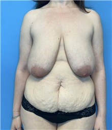 Mommy Makeover Before Photo by William Bruno, MD; West Hollywood, CA - Case 51365