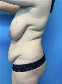 Mommy Makeover Before Photo by William Bruno, MD; West Hollywood, CA - Case 51365