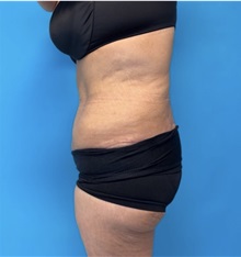 Body Lift After Photo by William Bruno, MD; West Hollywood, CA - Case 51373