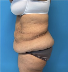 Body Lift Before Photo by William Bruno, MD; West Hollywood, CA - Case 51373