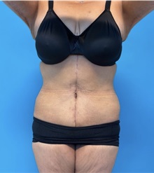 Body Lift After Photo by William Bruno, MD; West Hollywood, CA - Case 51373