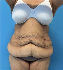 Body Lift Before Photo by William Bruno, MD; West Hollywood, CA - Case 51373