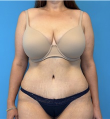 Tummy Tuck After Photo by William Bruno, MD; West Hollywood, CA - Case 51369