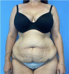 Tummy Tuck Before Photo by William Bruno, MD; West Hollywood, CA - Case 51369
